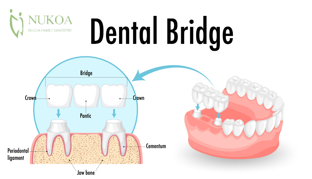 Dental Bridges