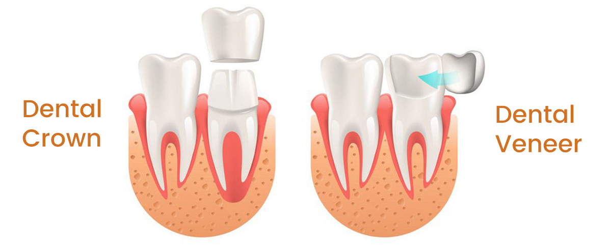 Dental Veneers vs. Crowns